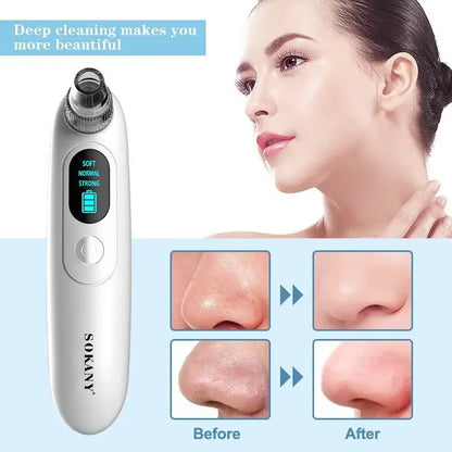 SOKANY Blackhead Remover